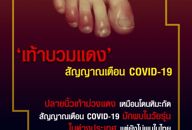 นิ้วเท้าบวมแดง สัญญาณเตือน โควิด-19 รูปแบบใหม่