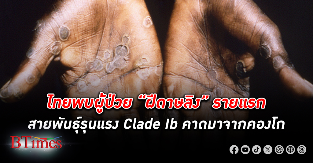 พบผู้ป่วยโรค “ฝีดาษลิง” รายแรกในไทย เป็นสายพันธุ์รุนแรง “สายพันธุ์ Clade Ib” คาดมาจากประเทศคองโก